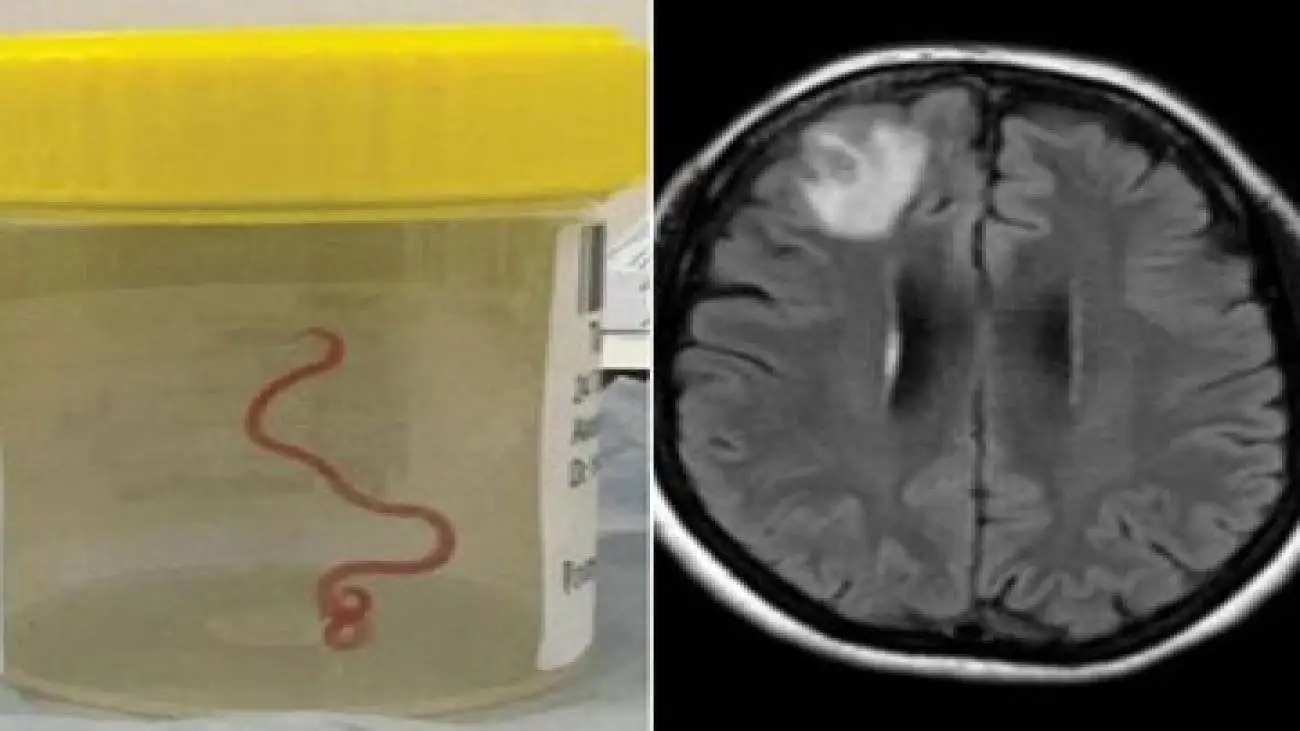 خارج کردن کرم 18 سانتی متری از مغز یک مرد -  عکس