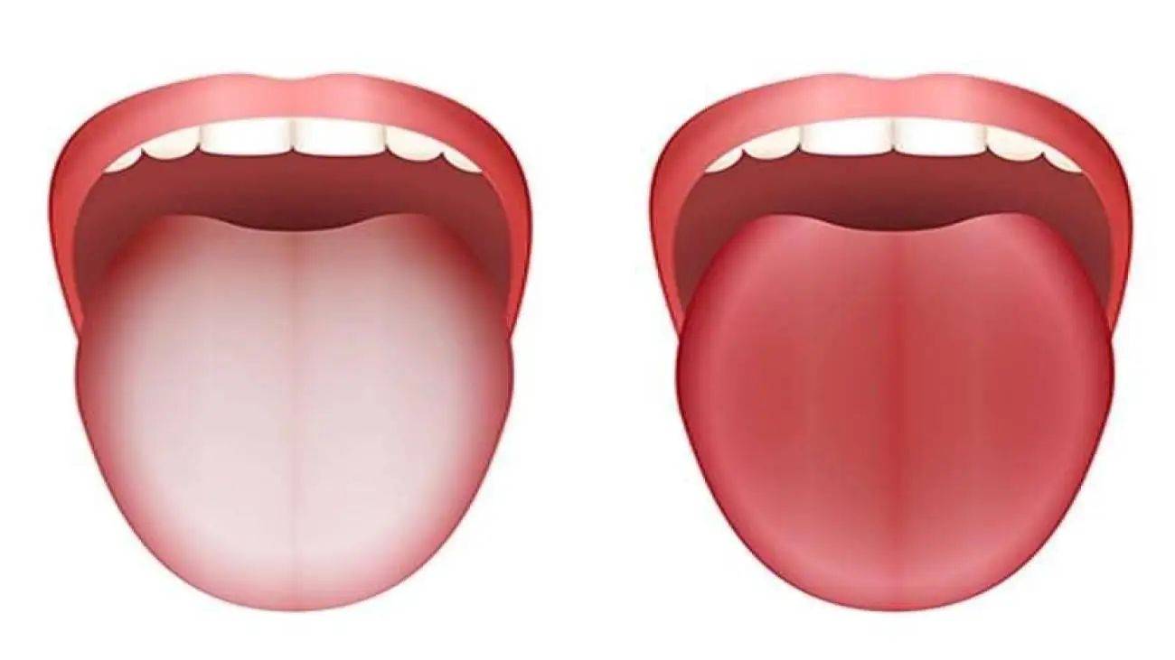 زبان سفید چه چیزی درمورد سلامت می گوید؟
