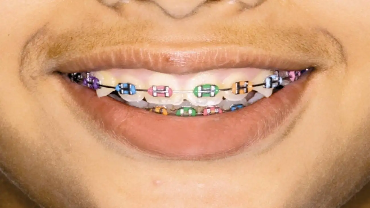 چگونه با ارتودنسی مسواک بزنیم؟