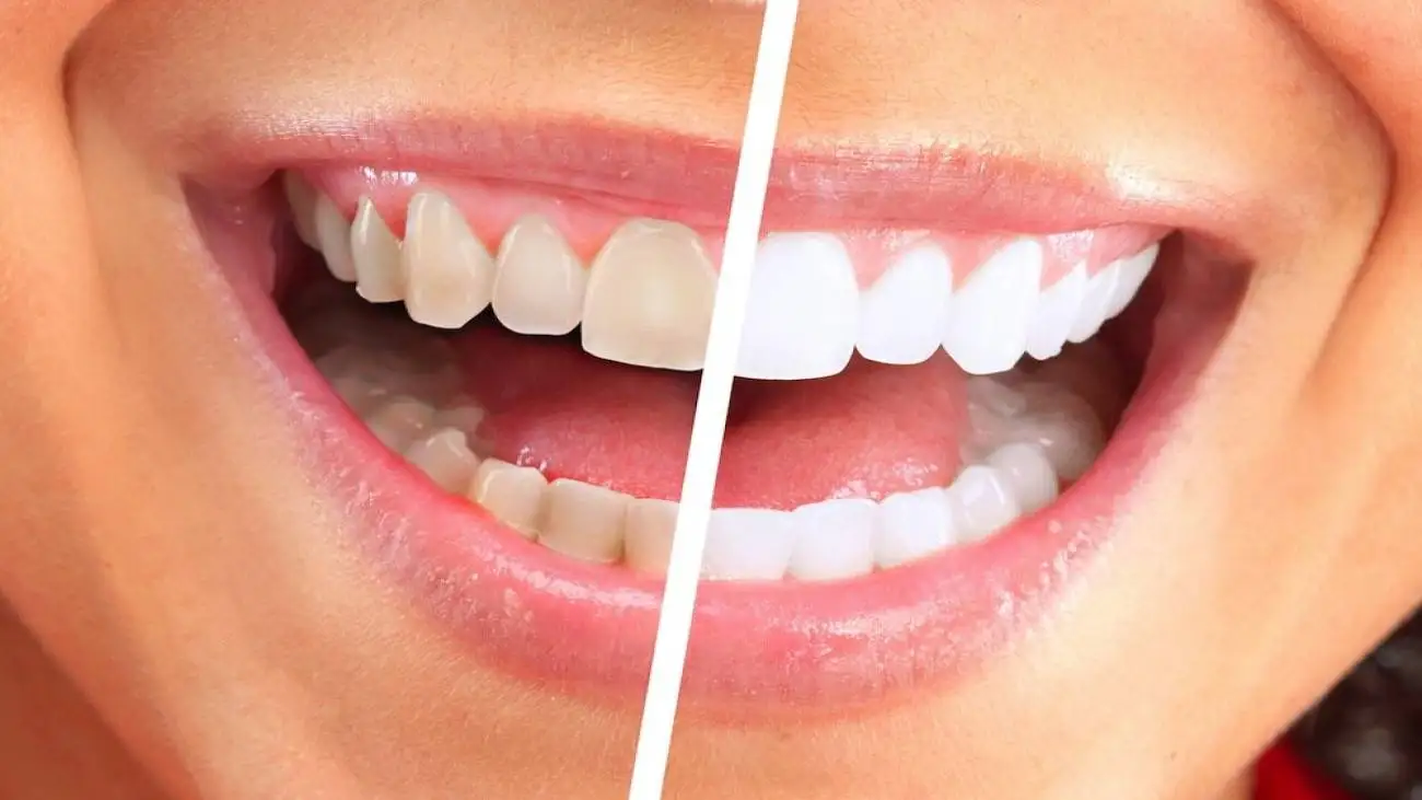 رنگ دندان ها چه چیزی درمورد سلامت شما می گوید؟  -  خطرناک ترین لکه چه رنگی است؟