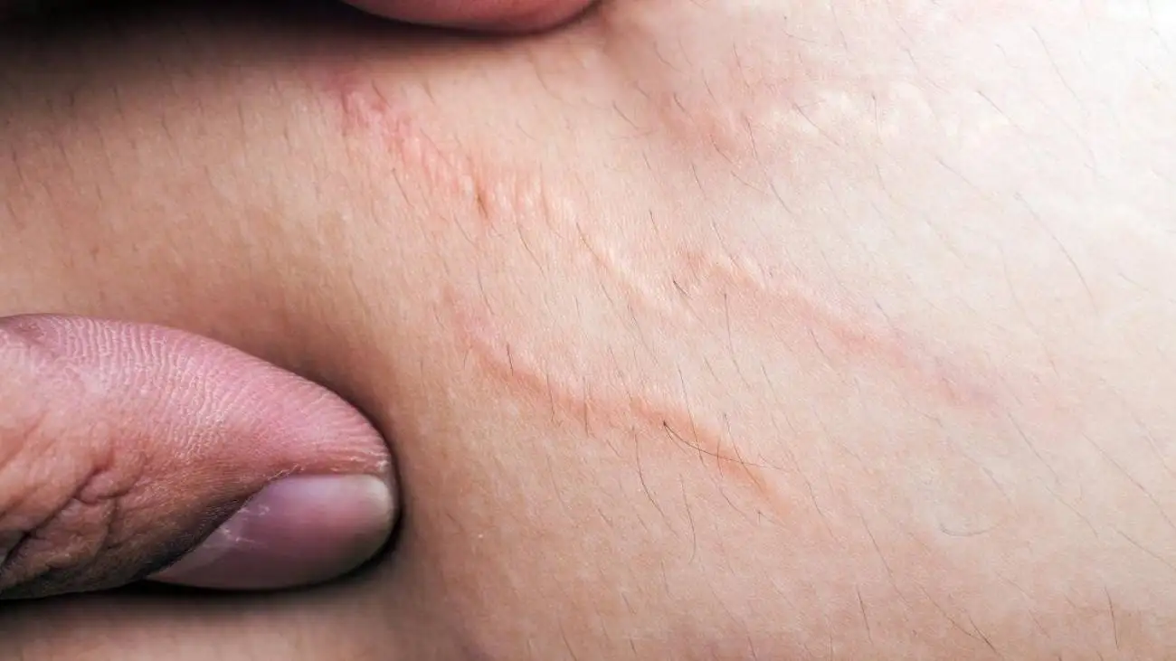 درمان ترک های پوستی؛ (درمان قطعی) وجود دارد؟