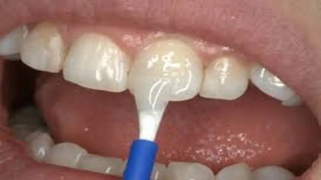 فلورایدتراپیِ دندانِ کودکان را از این سن آغاز کنید  -  یک باور غلط رایج درمورد عوارض فلورایدتراپی