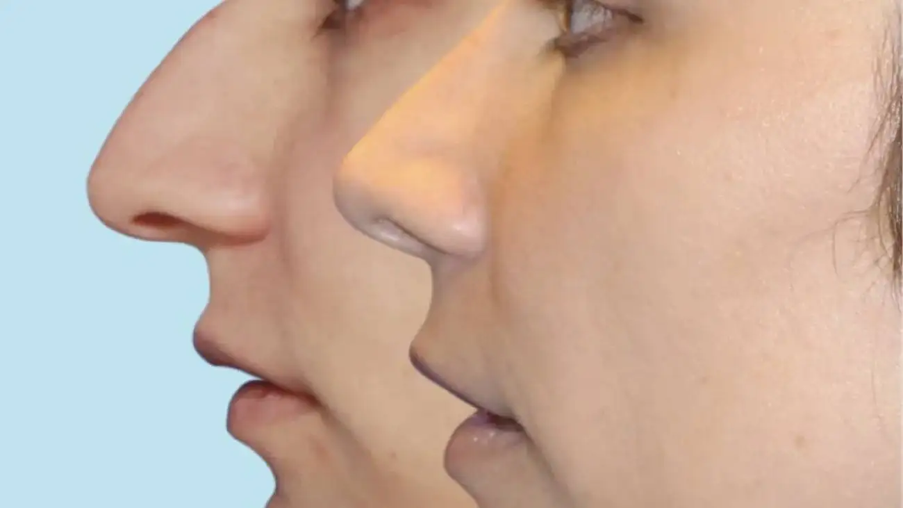 رونمایی از نخستین جراحی (بینی قوزدار) در ایران؛ آیا واقعا قوز بینی ترند زیبایی سال 2026 است؟