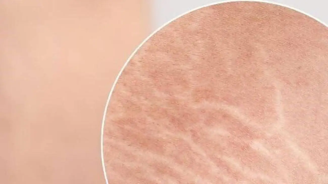 ترک های پوستی؛ علل ایجاد و روش های درمان