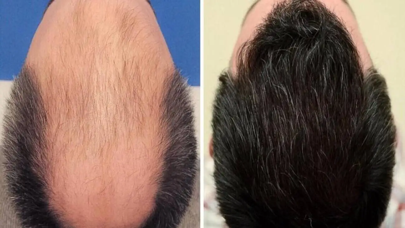 آیا کاشت مو دائمی است یا احتمال ریزش دوباره وجود دارد؟ بررسی واقعیت ها