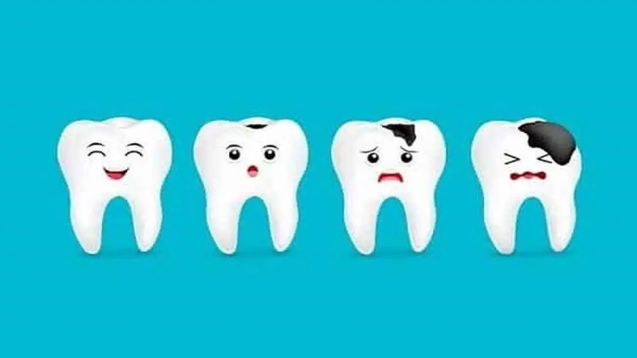 چگونه از پوسیدگی دندان جلوگیری کنیم؟