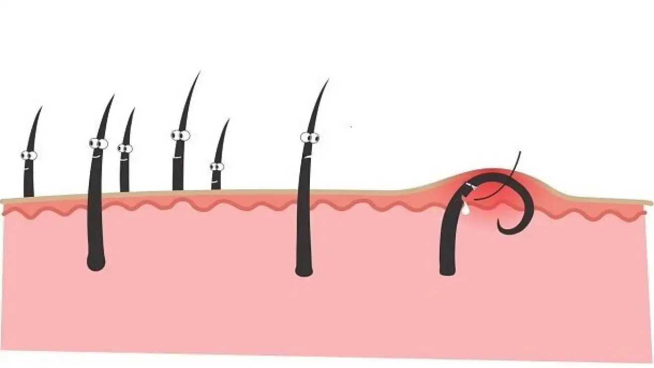 موی زیر پوستی چیست و چگونه می توان آن را درمان کرد؟