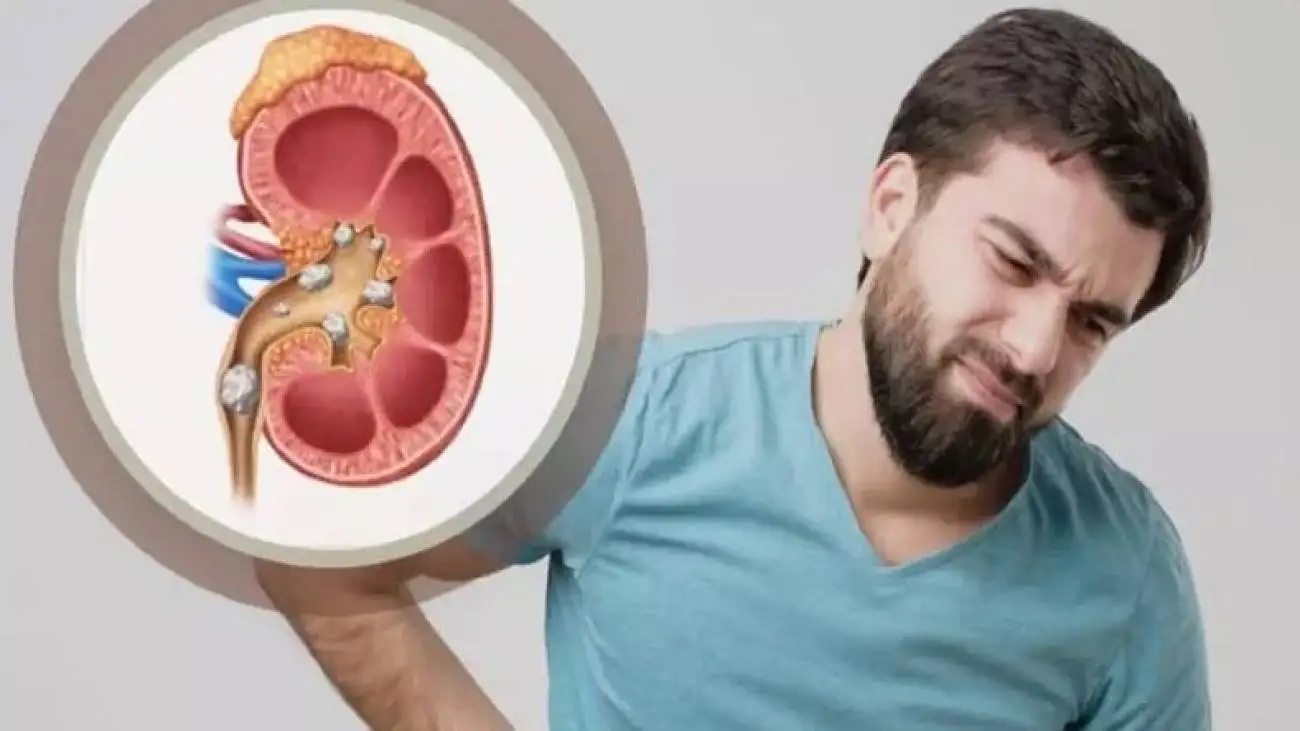 آیا آب مصرفی در کشور باعث سنگ کلیه می شود؟ + ویدئو