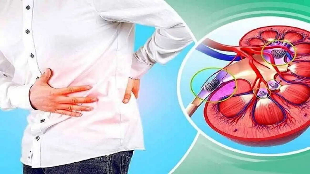 سنگ کلیه و دلیل تشکیل آن چیست ؟ ؛ علائم شایع سنگ کلیه