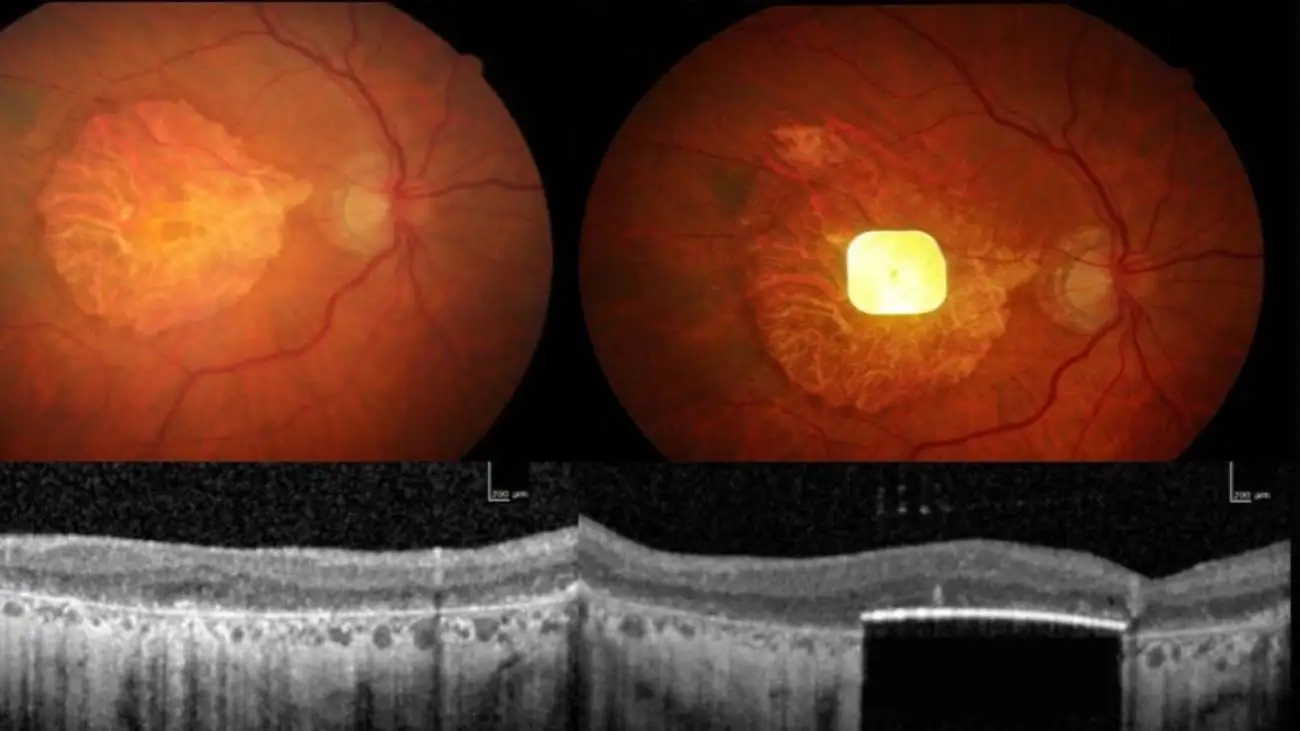 ایمپلنتی که بینایی را بازمی گرداند  -  کوتاه از دنیای فناوری
