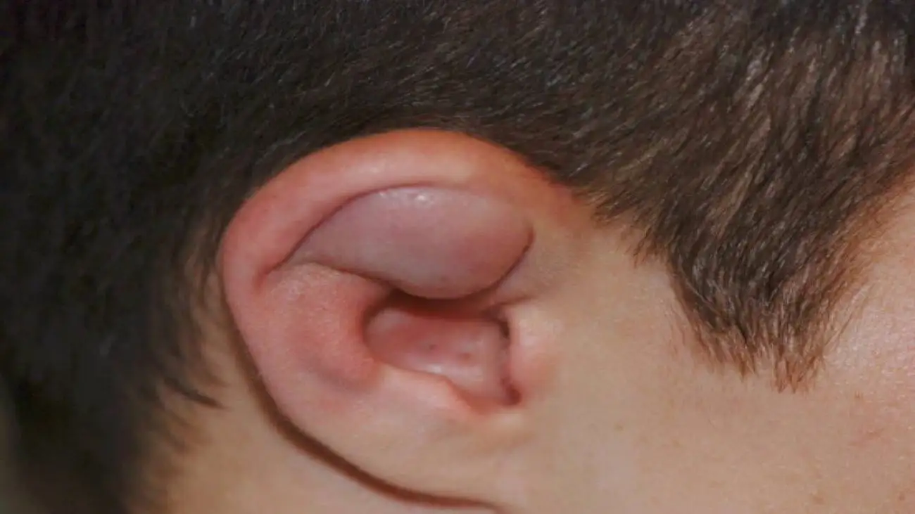 سرطان لاله گوش چیست و چه علائمی دارد؟