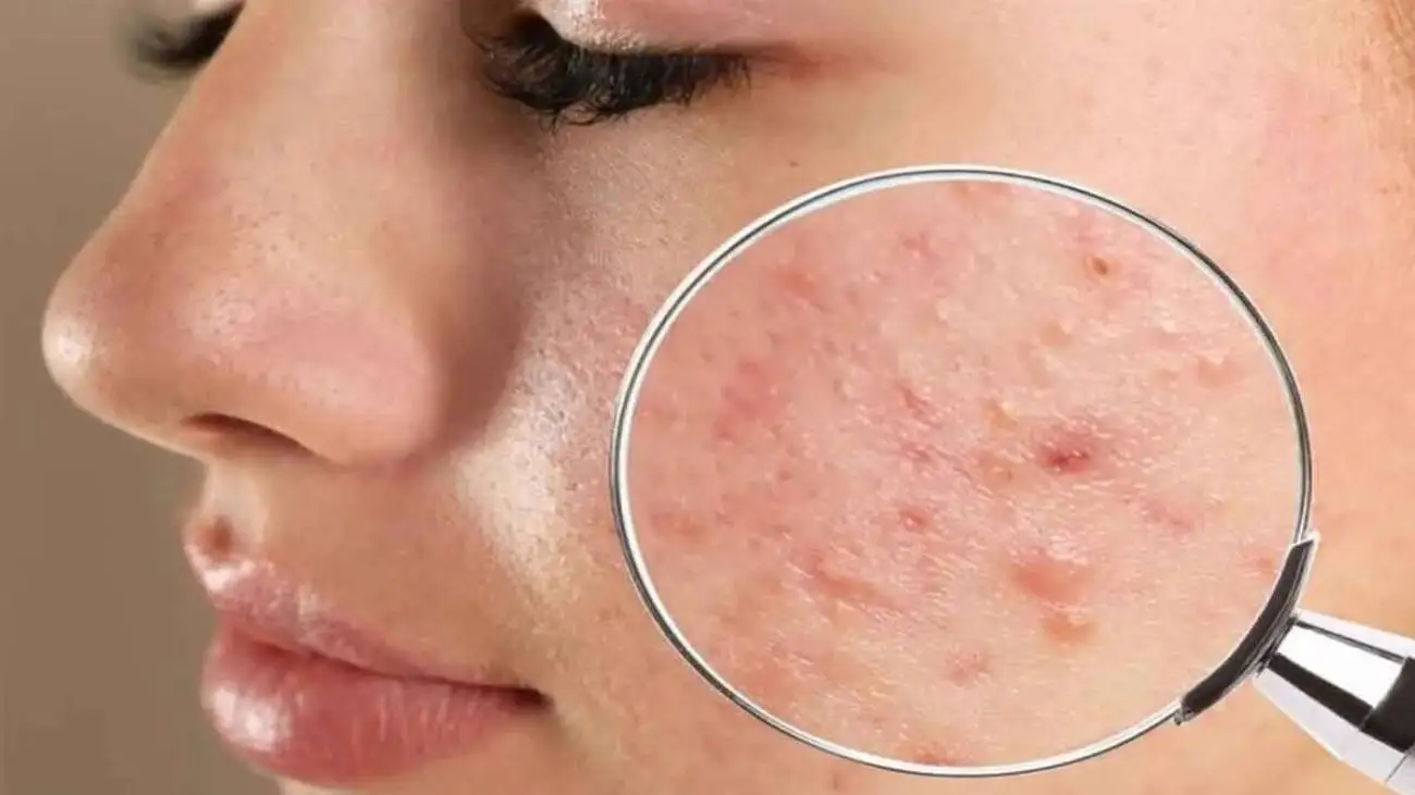 دلیل اصلی جوش چرکی چیست ؟ ؛ درمان خانگی جوش های چرکی و دردناک