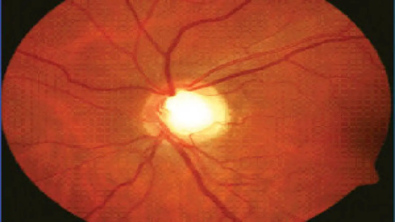 هوش مصنوعی در تشخیص این بیماری از متخصصان پیشی می گیرد