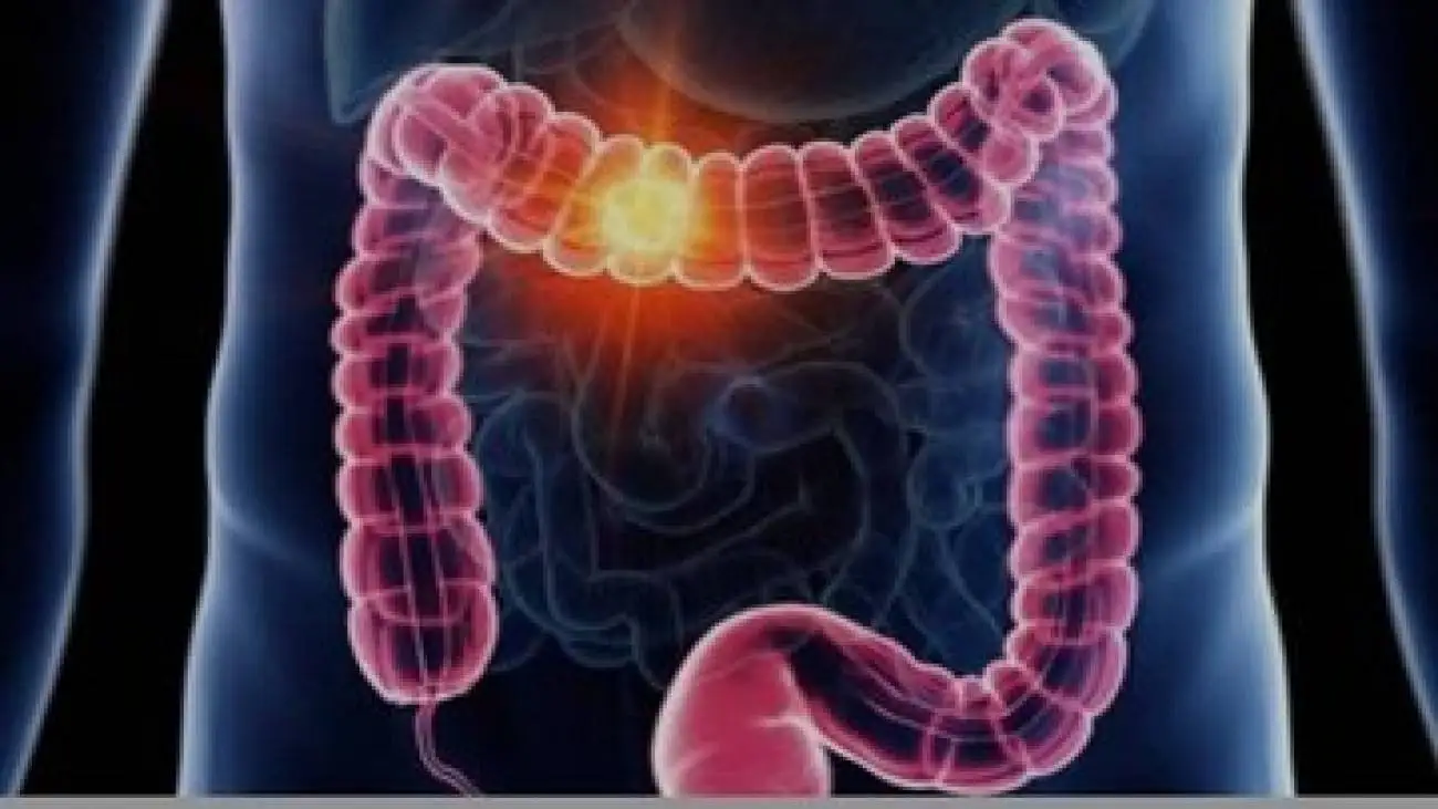 علائم گوارشی را ساده نگیرید -  هر خون ریزی هموروئید نیست