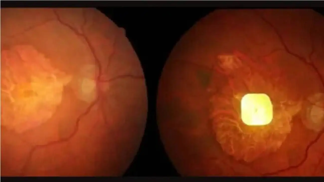 ایمپلنت چشمی که به نابینایان قدرت خواندن متون را می دهد