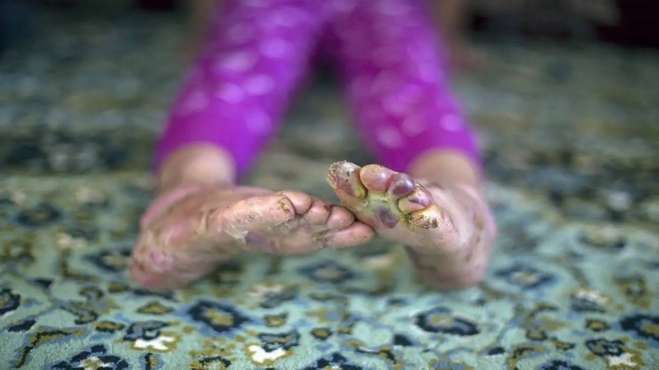 5 شکایت رسمی بیماران پروانه ای از بنیاد بیماری های خاص  -  ماجرای رها شدن یک نوزاد پروانه ای در بیمارستان