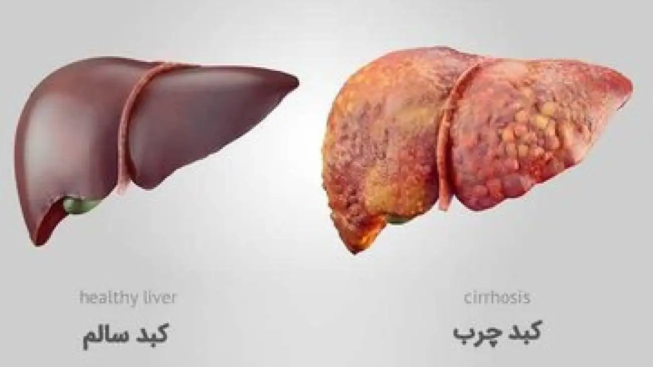 خوراکی های مفید و مضر برای کبد را بشناسید