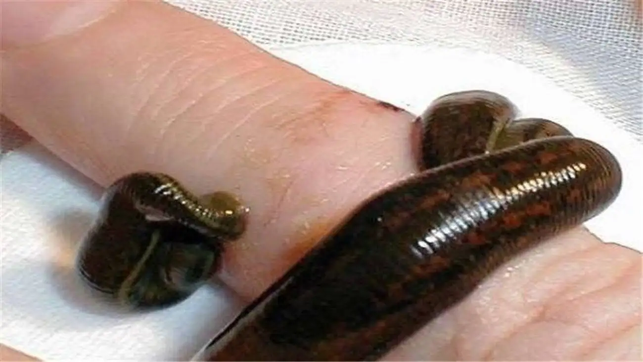 کمک به بیماران پسوریازیس با  (زالو درمانی)؛ معجزه ای دیگر از طب سنتی