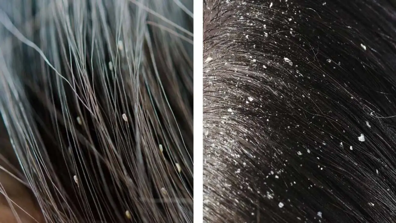 تفاوت پوسته سر و شوره سر ؛ علت، علائم و روش درمان پوسته سر