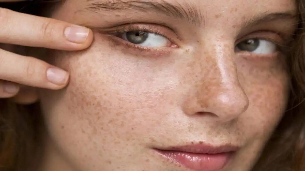 آشنایی با انواع لک های پوستی