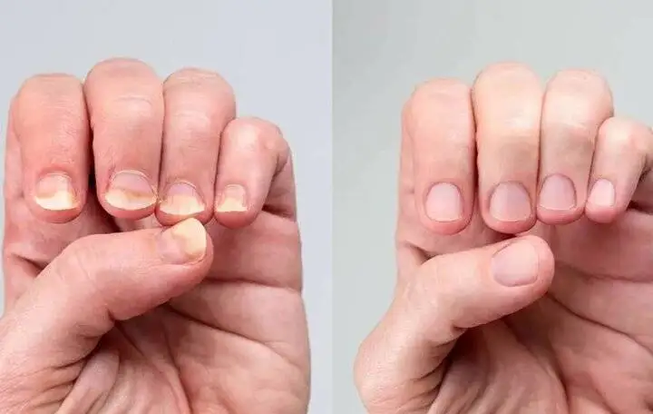 این 7 نشانه در ناخن یعنی کلسترول شما بالا رفته است