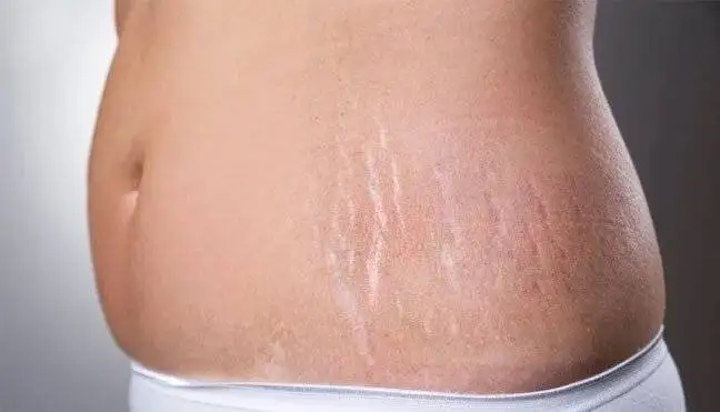 ترک های پوستی؛ علل ایجاد و روش های درمان