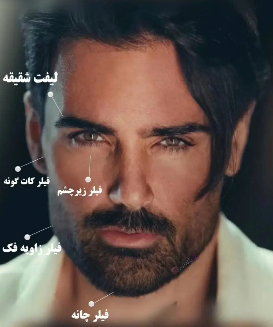 تصویر - تغییرات اساسی در چهره سهراب پاکزاد بعد از عمل زیبایی!