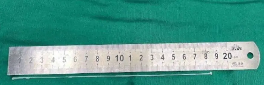 خارج کردن کرم 18 سانتی متری از مغز یک مرد - عکس