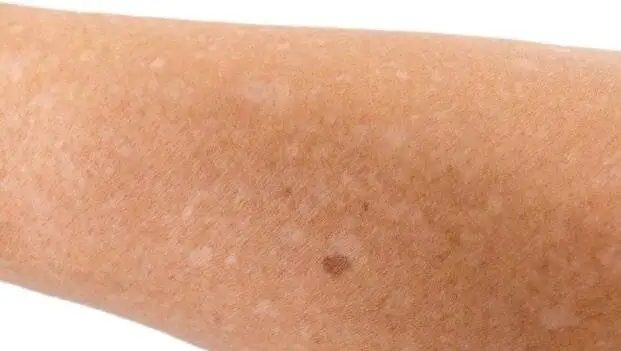 آشنایی با انواع لک های پوستی