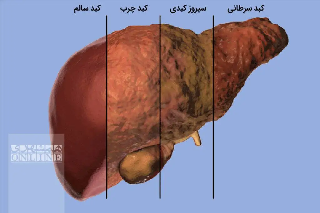 با این غذاها کبد چرب را ضربه فنی کن ! ؛ رژیم غذایی برای کبد چرب