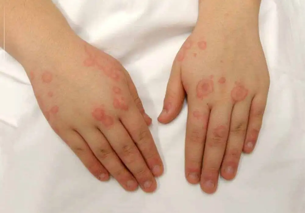 این بیماری در کودکان خطرناک تر است - چطور پیشگیری کنیم؟