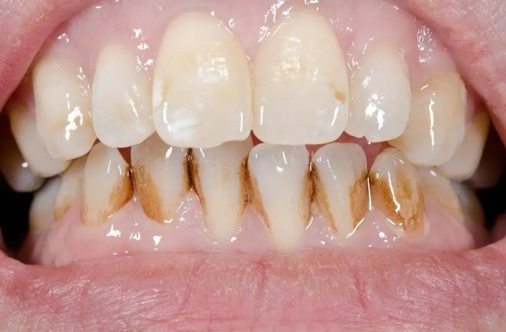 رنگ دندان ها چه چیزی درمورد سلامت شما می گوید؟ - خطرناک ترین لکه چه رنگی است؟