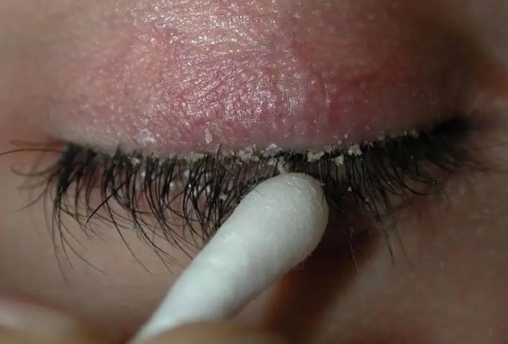 بلفاریت چشم چیست و چگونه درمان می شود؟