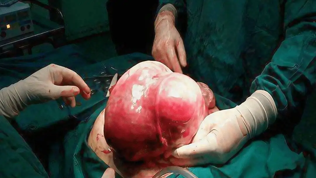 خارج کردن توده 7 کیلویی از بدن بیمار اردبیلی - عکس