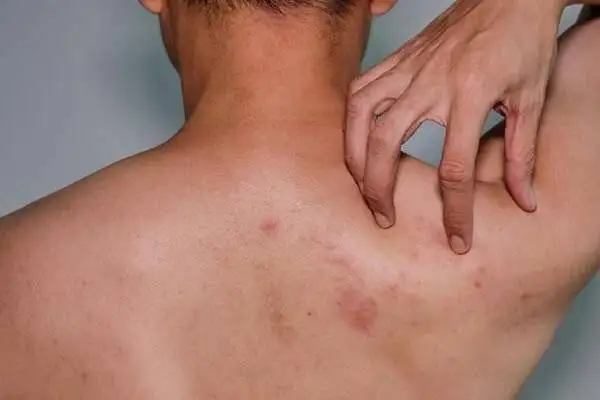 جوش روی کمر نشانه چیست و چگونه درمان می شود؟