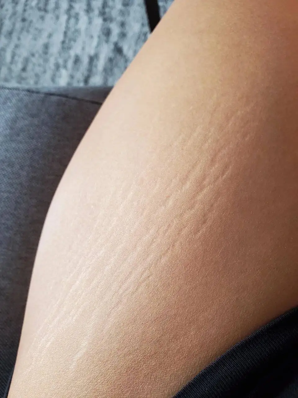 درمان ترک های پوستی؛ (درمان قطعی) وجود دارد؟