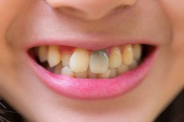 رنگ دندان ها چه چیزی درمورد سلامت شما می گوید؟ - خطرناک ترین لکه چه رنگی است؟