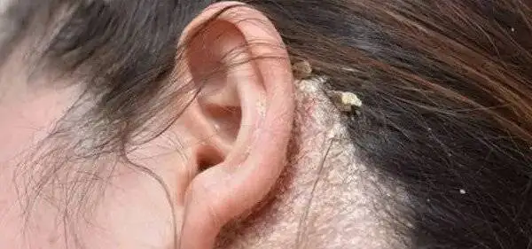 تفاوت پوسته سر و شوره سر ؛ علت، علائم و روش درمان پوسته سر