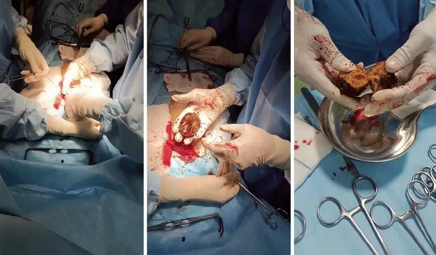 توده جالب خرمالو در معده چند بیمار + عکس