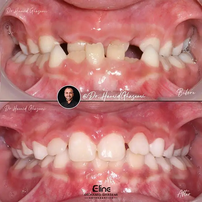 ارتودنسی بدون جراحی فک؛ مرز بین درمان علمی و توقع غیرواقعی بیماران