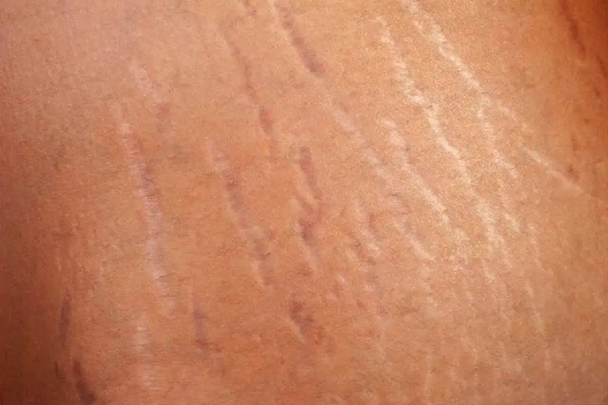 ترک های پوستی؛ علل ایجاد و روش های درمان