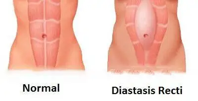 شکاف عضلات راست شکمی پس از زایمان: از تحقیقات پایه تا عمل بالینی + عکس