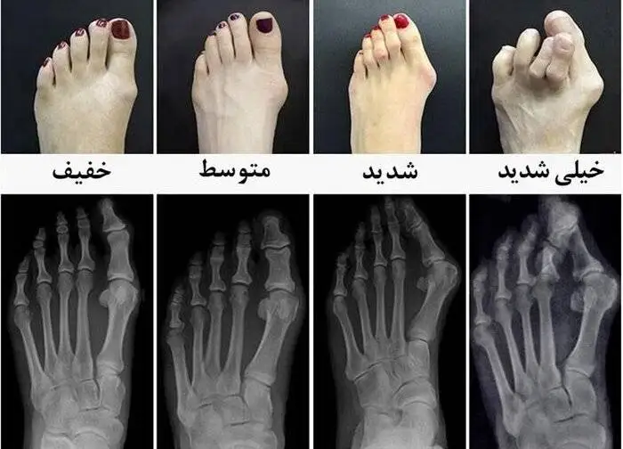 برای اصلاح انگشتان خم شده پا چه کار کنیم؟