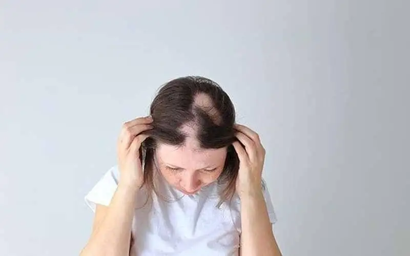 ریزش مو ناشی از کم خونی؛ ارتباطی نادیده گرفته شده