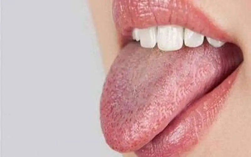 زبان سفید چه چیزی درمورد سلامت می گوید؟