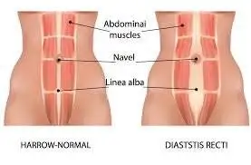 شکاف عضلات راست شکمی پس از زایمان: از تحقیقات پایه تا عمل بالینی + عکس
