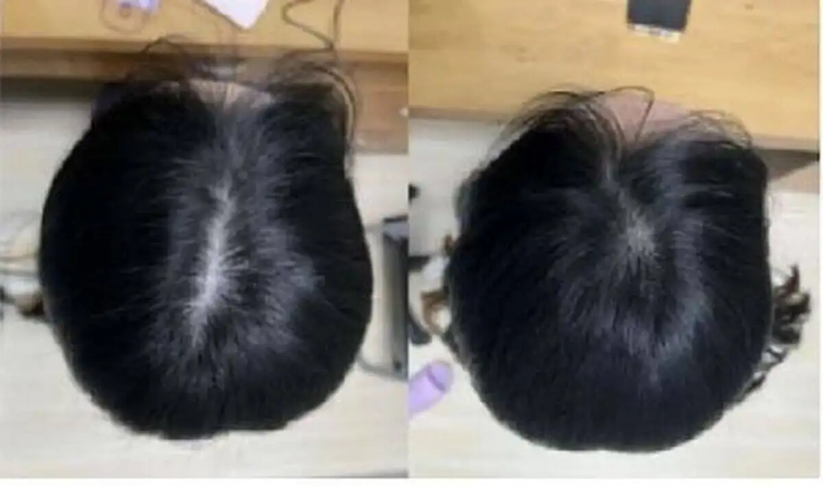 آخرین متد درمان طاسی