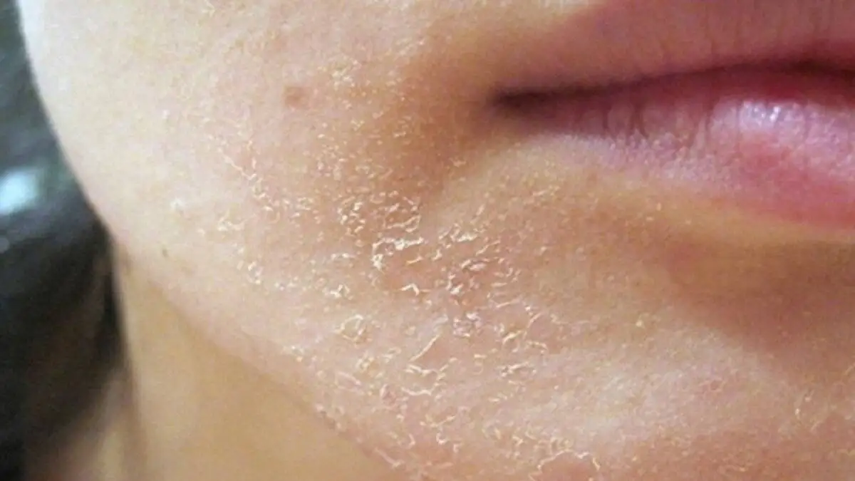 دلیل زبری و پوسته پوسته شدن پوست ؛ چطور می توان از آن پیشگیری کرد؟