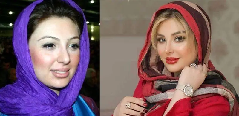 رونمایی از تصاویر قبل عمل زیبایی بازیگران زن ایرانی - از شیلا خداداد تا نیوشا ضیغمی+عکس