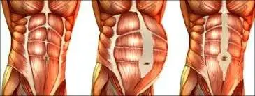 شکاف عضلات راست شکمی پس از زایمان: از تحقیقات پایه تا عمل بالینی + عکس